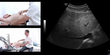 El ultrasonido de abdomen completo evalúa las vísceras abdominales, puede hacerse como chequeo.