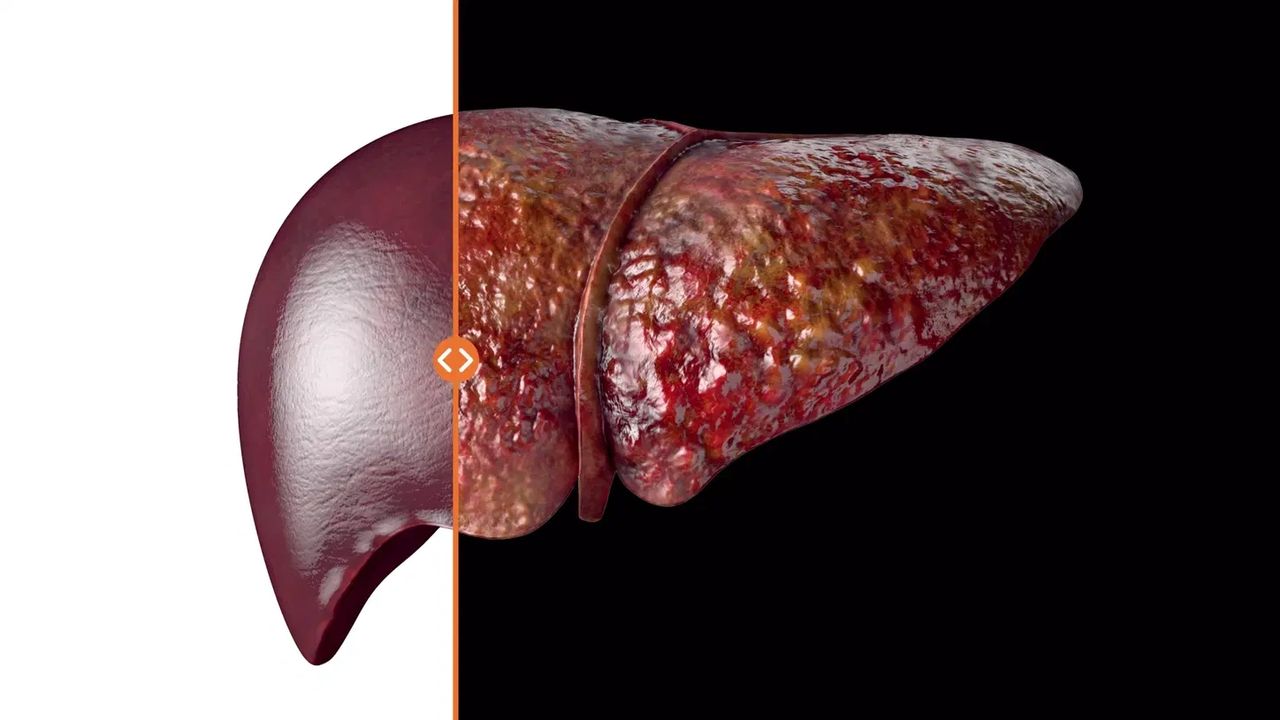 fibrosis hepática, cirrosis, hígado graso y elastografía hepática. fibrosis hepática, cirrosis, hígado graso y elastografía hepática.