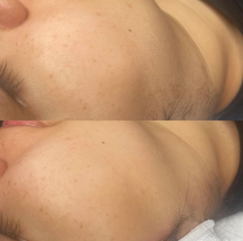 Before & after of a dermaplane facial. 