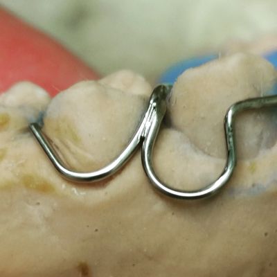Laser Welded labial bow to bicuspid clasp