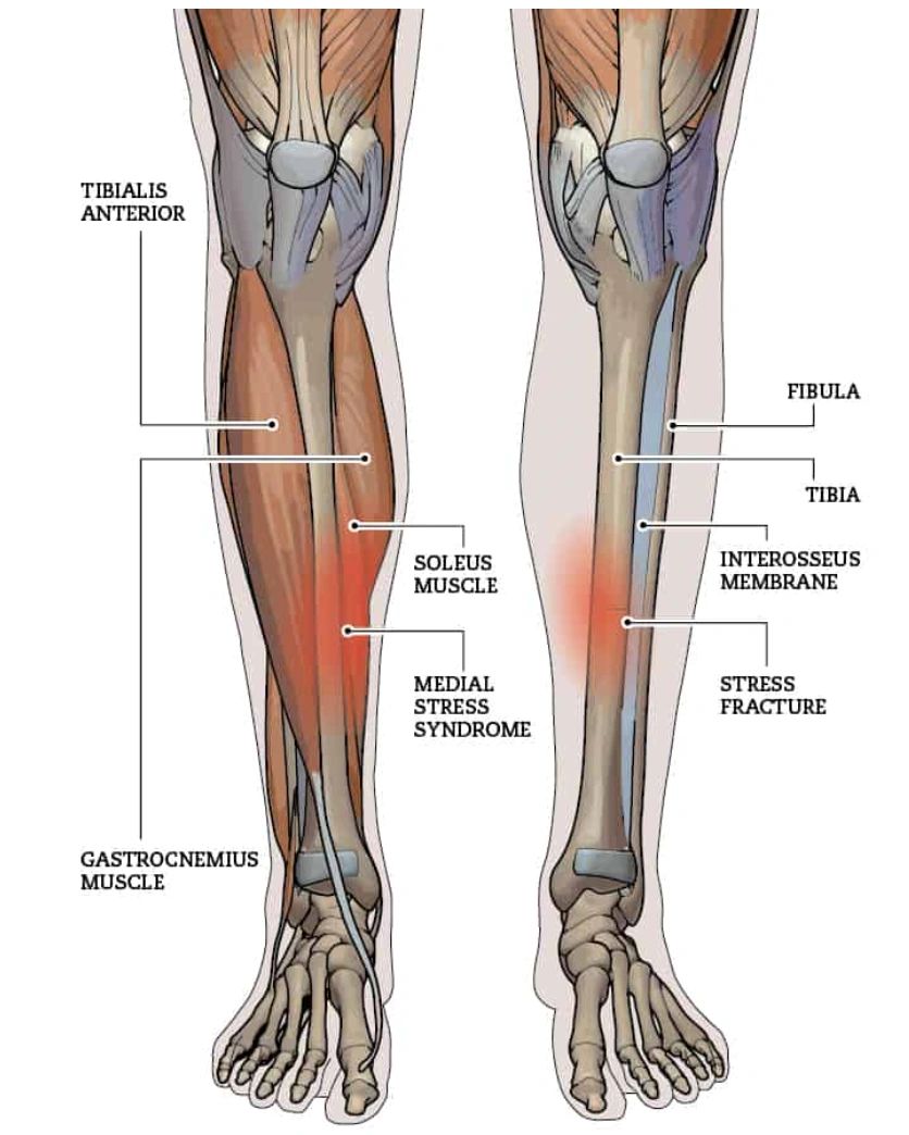 Understanding Shin Splints Causes Symptoms And Treatment 1347