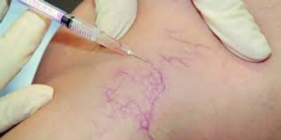 microsclerotherapy picture of small thread veins being injected 