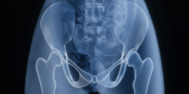 X-ray image showing the pelvis and hip bones.