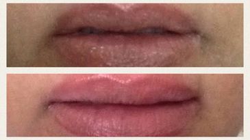 Lip augmentation with Versa lips