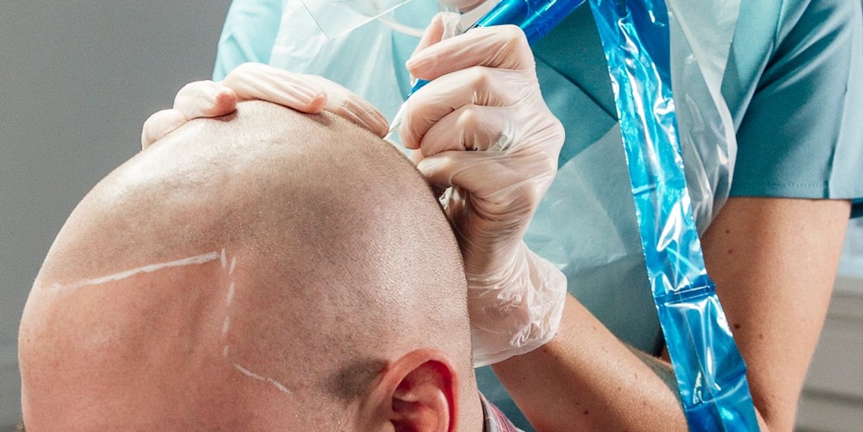 Scalp Micropigmentation North West procedure