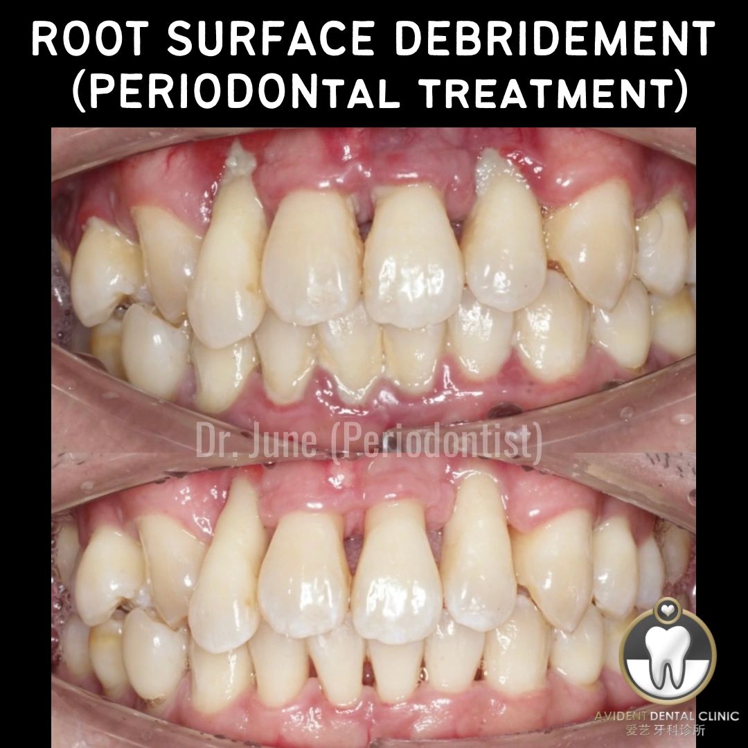 Root Surface Debridement (Root Planing)