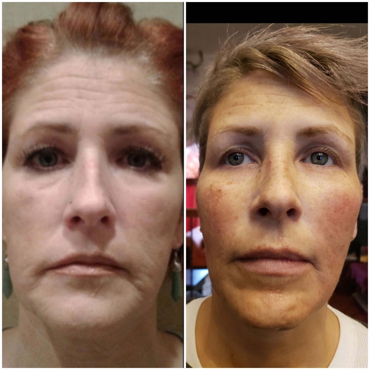 The Aging Face & What can do to improve our appearance? 5 steps to facial rejuvenation 