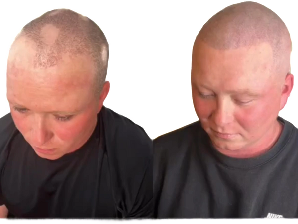 Perfect hair loss solution For Alopecia 