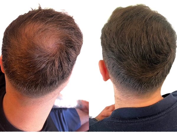 Love your hair but thinning...then keep it with smp density