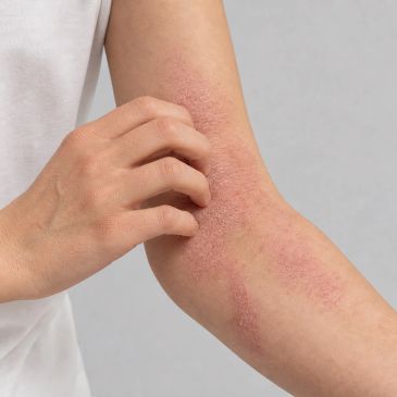 Person scratching an irritated rash on their arm.