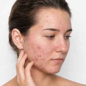 Young woman with acne on her cheek.