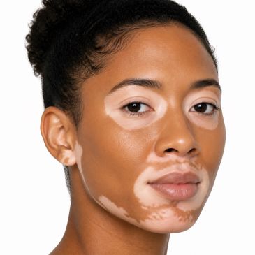 Close-up of a woman with vitiligo.