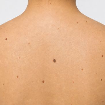 Back with multiple moles and one larger dark mole.