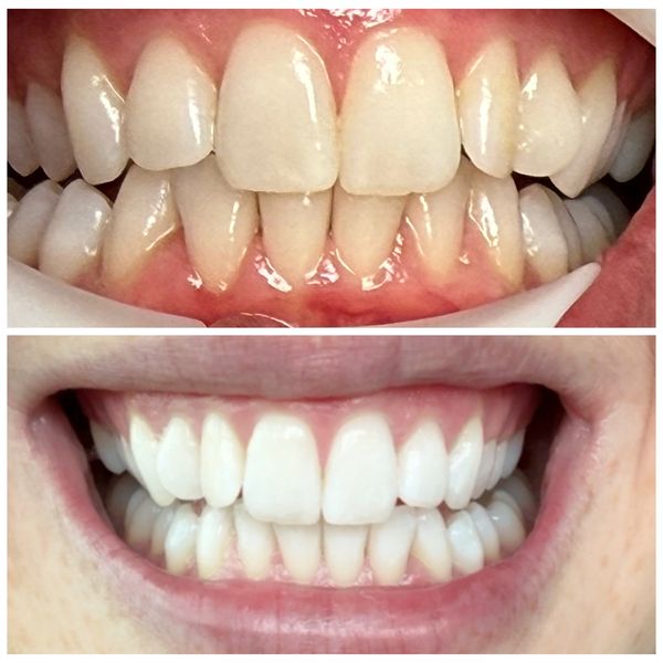Before and after teeth whitening showing significant improvement in color and brightness.