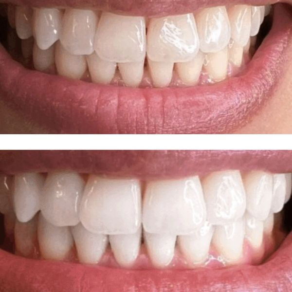 Comparison of teeth before and after whitening treatment.