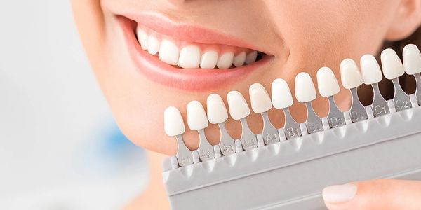 Close-up of a smile with a dental shade guide for teeth whitening.