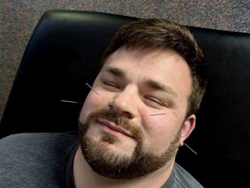 Man receiving facial acupuncture with needles in cheeks.
