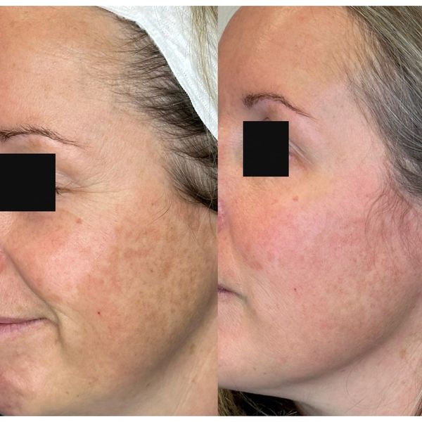 Defined Jawline using PDO threads microneedling