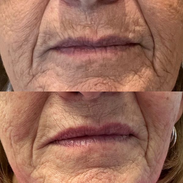 before and after of perioral lines and lips treated with filler and PDO threads
