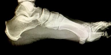 Quad Cities Chiropractor and Personal Trainer for plantar fasciitis and shoulder pain in Bettendorf