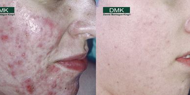 Before & after of DMK enzyme therapy  for mild to severe hormonal, cystic & acne rosacea.