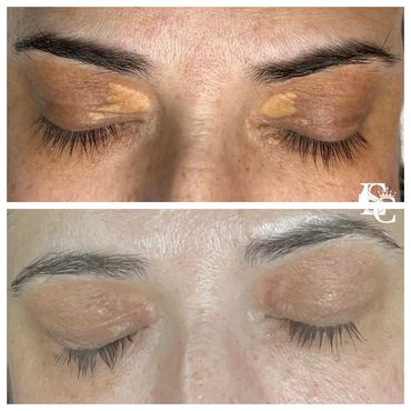 Lady with xanthelasma on her eyelid saw improvement after removal with Skin Classic