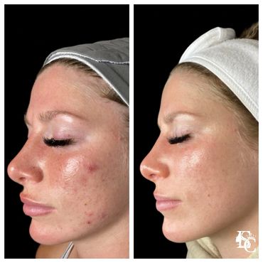Caucasian lady with acne and rosacea