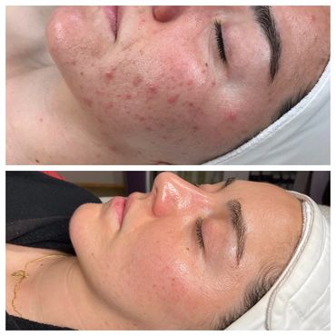 Before and after picture of a woman with hormonal and adult acne