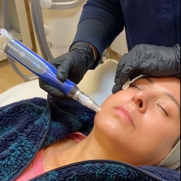 A woman on her 40's getting SkinPen Microneedling with Exosome