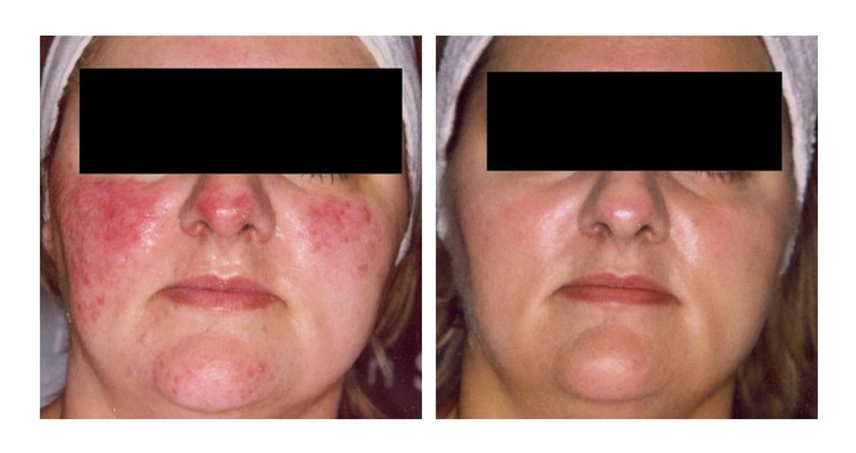 DMK Enzyme Therapy for rosacea.