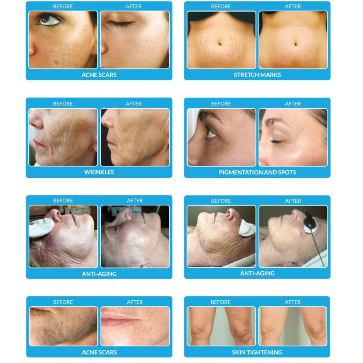 ProCell Therapies Microchanneling is excellent for wrinkles, age spot, stretch marks, acne scars