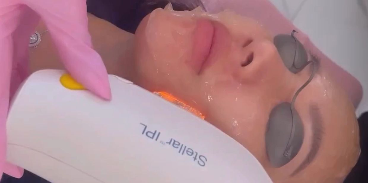 Woman with age spots, freckles, sun damage getting IPL