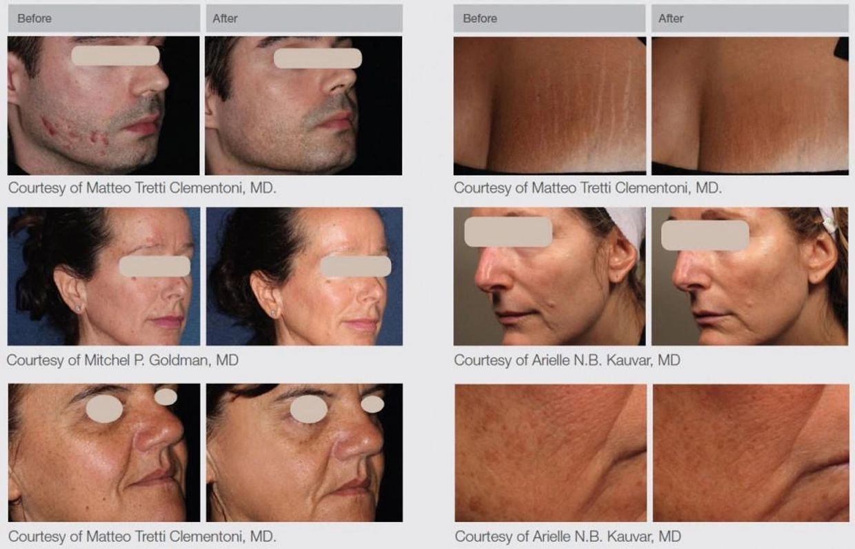 Before and after results of ResurFX or laser skin resurfacing for surgical scars & stretch marks