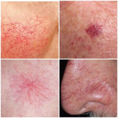 Telangiectasia are small dilated blood vessels near the surface of the skin or mucous membranes.