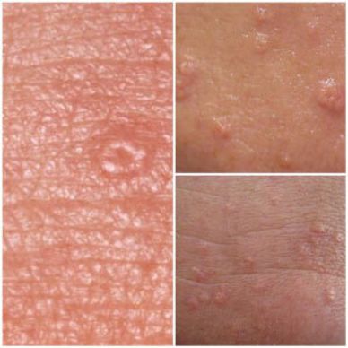 Sebaceous hyperplasia is a common, benign condition of sebaceous glands in adults of middle age 