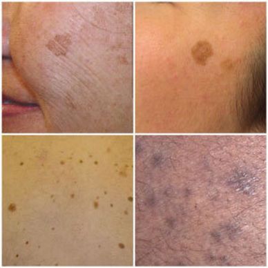 Flat hyperpigmentation and dermatosis papulosa nigra