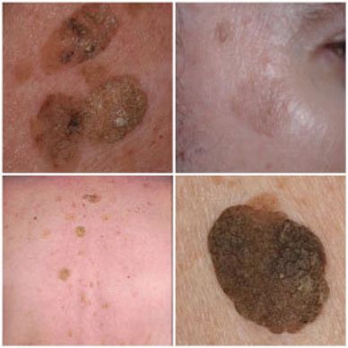 Seborrheic Keratosis