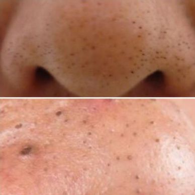 Clogged pores or blackheads