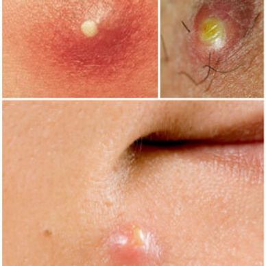Cystic acne or acne vulgaris