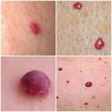 Cherry angioma