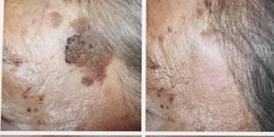Before & after of removal for sunspots, keratosis, age spots & scar from post traumatic injury.
