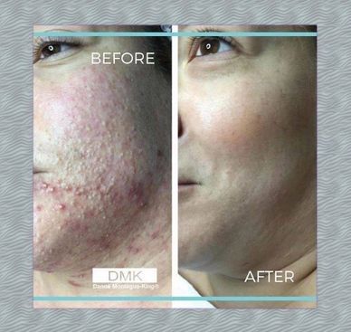 Before & after of a woman who had DMK acne treatment for severe non-inflamed acne.