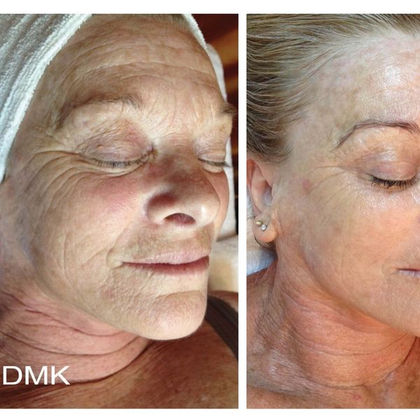 DMK Age Management for deep wrinkles, cross-linked wrinkles or glycated skin, hyperpigmentation