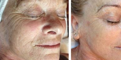DMK Enzyme Therapy before & after of woman with fine lines, deep wrinkle & sun damage.