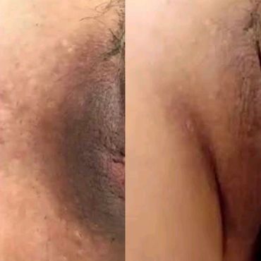 Discolored woman's intimate area