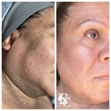 A woman with severe melasma on the face & neck & got improved with Hollywood Laser Peel