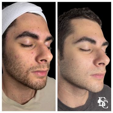 Before and after of a man with stubborn acne