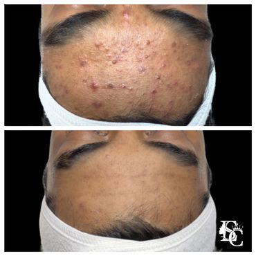 Before and after of a teen suffering from stubborn inflamed and non-inflamed forehead acne.