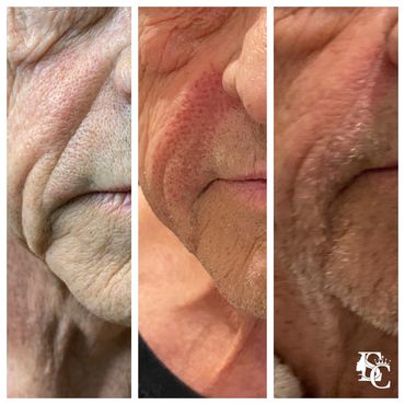 65 year old man who wants skin tightening on his nasolabial folds