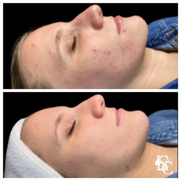 Non-inflamed acne before and after
